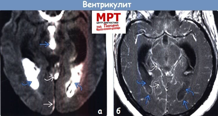МРТ диагностика вентрикулита в головном мозге