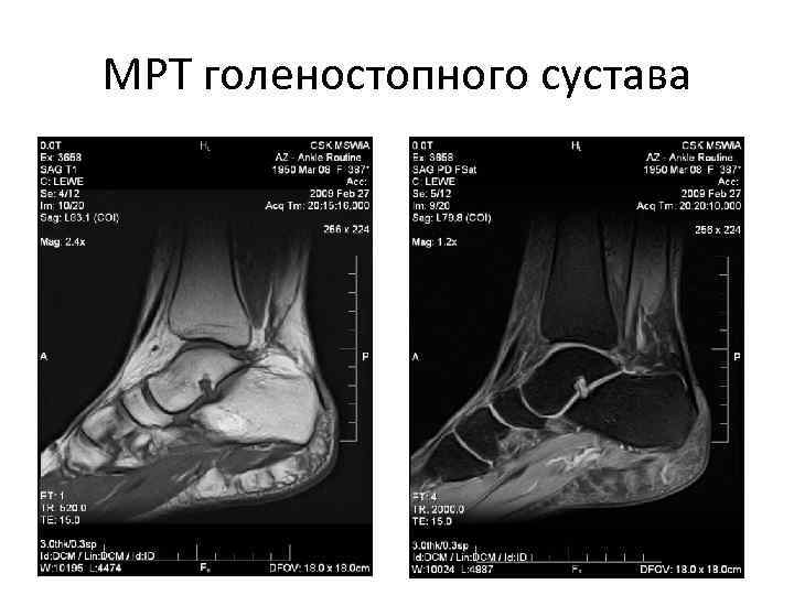 МРТ голеностопного сустава