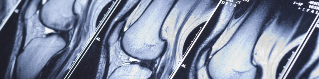 МРТ коленного сустава