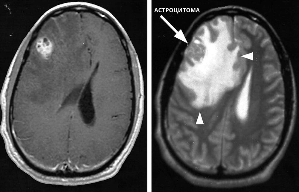 Астроцитома головного мозга выявленная с помощью МРТ