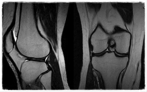 МРТ коленного сустава